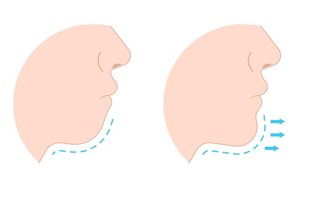 Jawline dolgu - Çene dolgusu